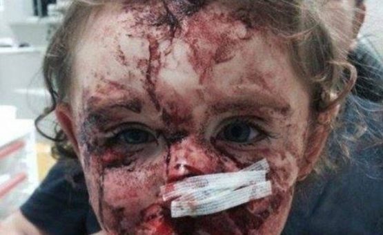 Bebê de 1 ano tem rosto destruído após sofrer ataque de cão.